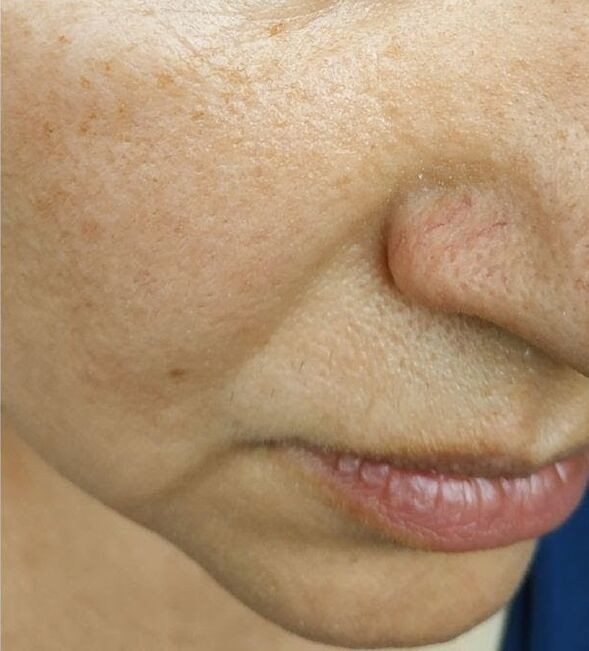 By the age of 40, labial wrinkles appeared
