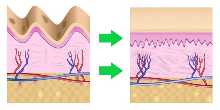 Intenskin aligned skin