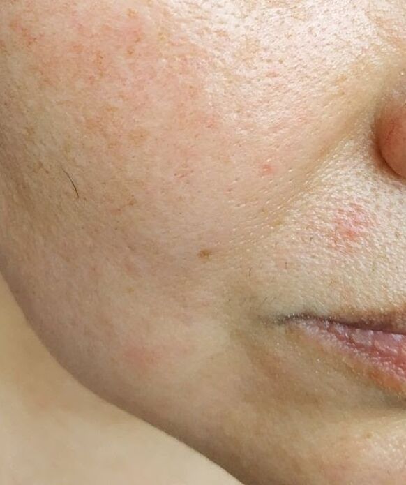 Intenskin gets rid of deep nose and labia folds