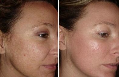 Laser face skin rejuvenation before and after photos