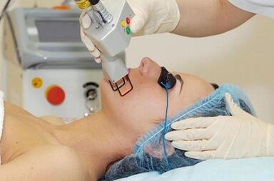 the renewal of laser facial skin